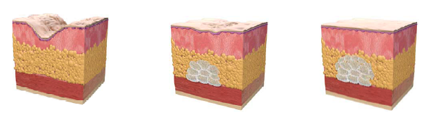 injection acide hyaluronique